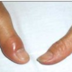 swollen painful thumb joints 9 mėnulio diena rekomendacijos sąnarių gydymas