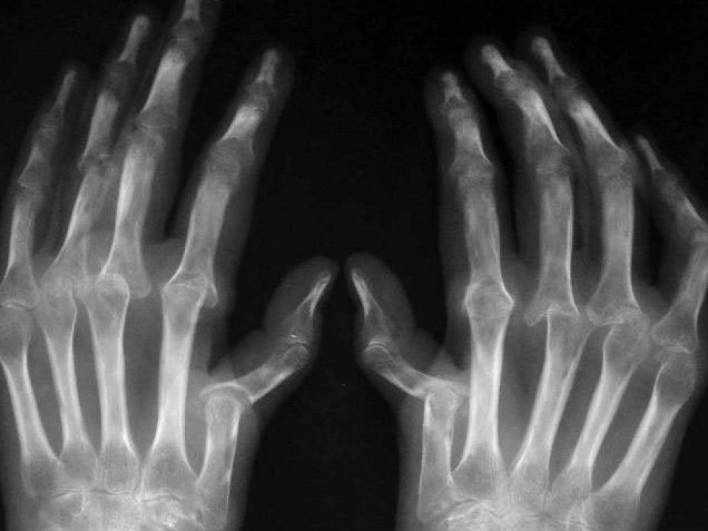 artritas sąnarių gydymo tradiciniais metodais osteoartrito peties sąnario žolelių terapijos