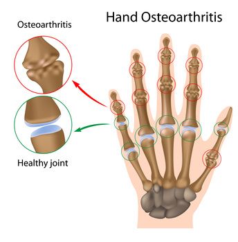 pirminio artrozė sąnarių osteoartritas