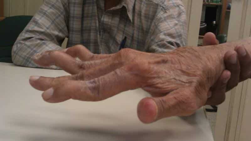 artritas iš mažų sąnarių sustaines riešo ligos