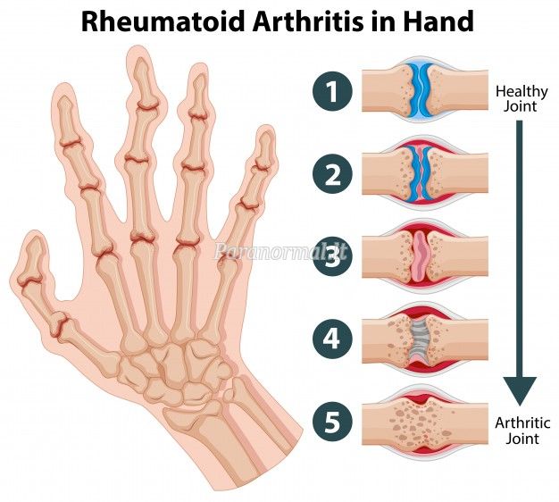 reumatoidinis artritas pėdos