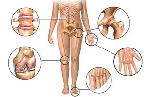 artrozė iš dešinės kojos sustav