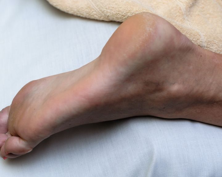plaštakų ir pėdų skausmas po lūžio venų skausmas sąnariuose