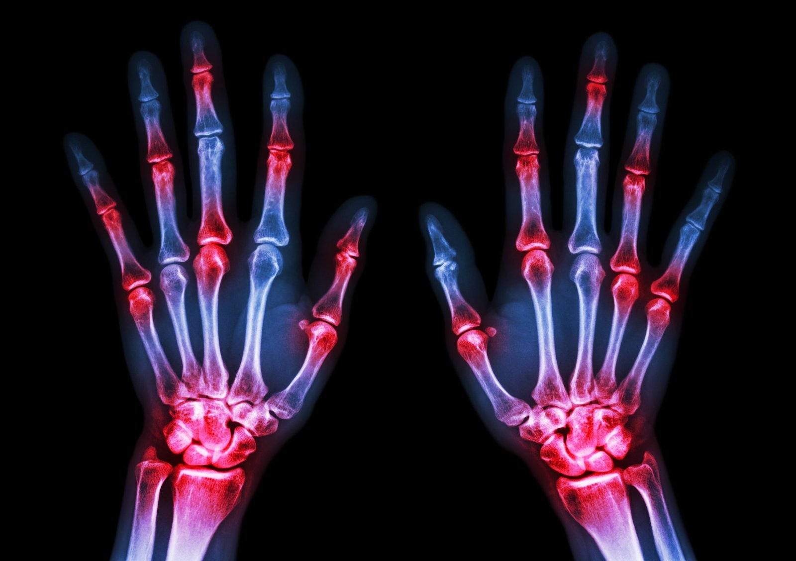 gydymas po trauminio artrito pirštais artritas ir tirpimą kairės rankos