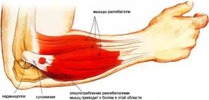 plėtra alkūnės sąnario artrozė