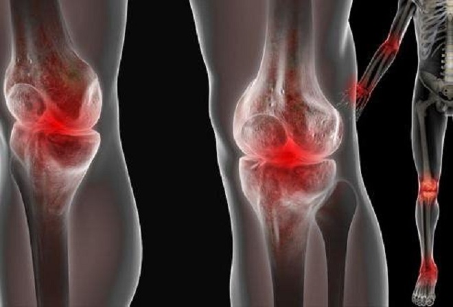 swelling in knee joints sąnarių uždegimą pirmosios pagalbos gydymo