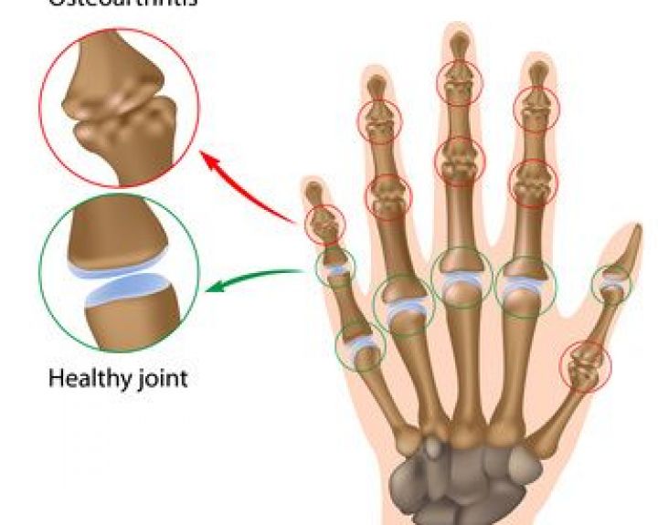 lomit kaulų ir sąnarių pagal liaudies gynimo artritas artrozė jų gydymas