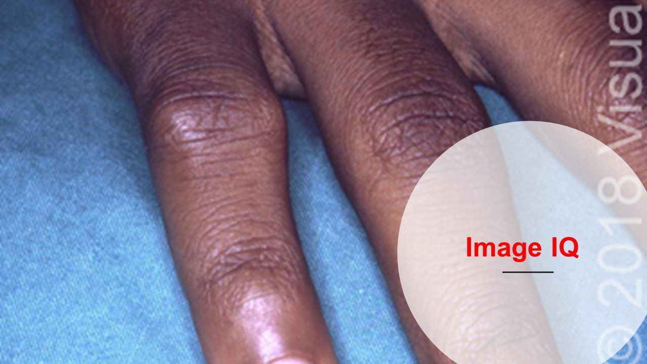 swollen painful finger joint gydymas artritu veido sąnario liaudies gynimo priemones