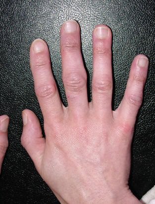 skausmas alkūnės sąnario kai lenkimo ir pratęsimo tipai artrito rankų