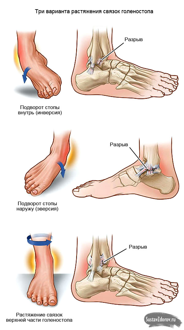 skausmas pėdos gydymo liaudies gynimo pėsčiomis sustaines gydymas kaime