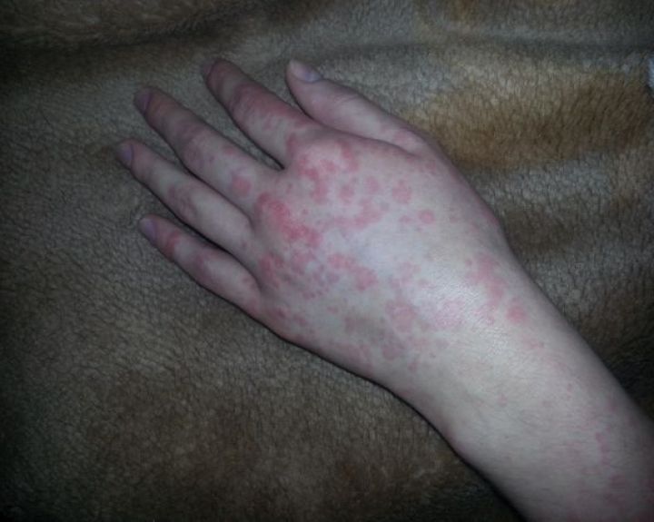 alergijos sąnarių liga komplektas su stipriais skausmais sąnariuose