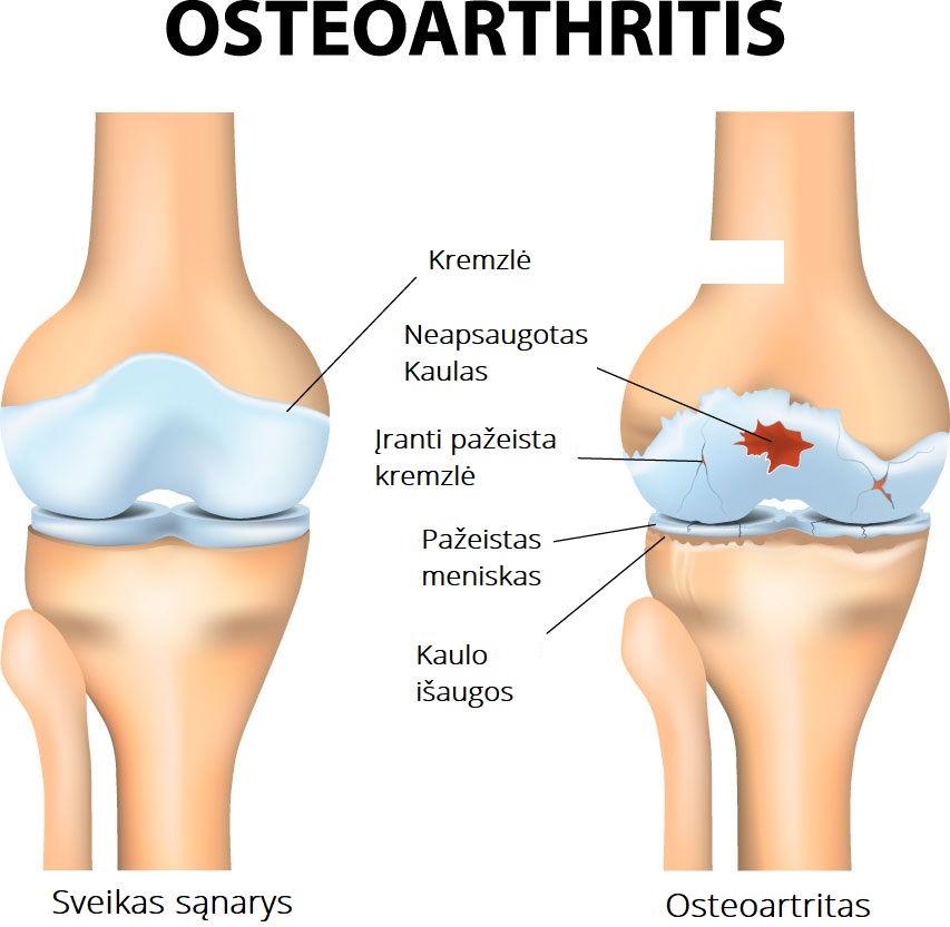 sąnarių skausmas kai juda reumatoidinis artritas iš pirštų sąnarių