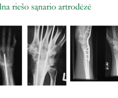 artritas iš pirštakaulis sąnario artritas rankų ir jo gydymas