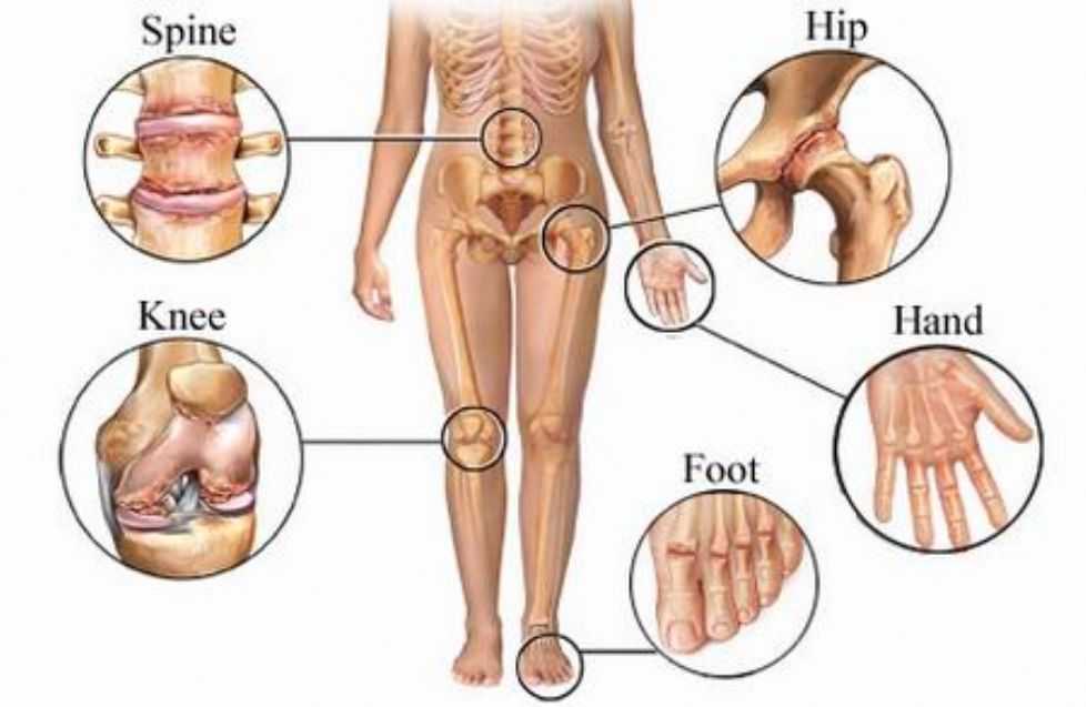 aktyvus reumatoidinis artritas sąnarių skauda tepalas