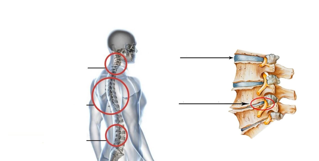 artritas artrozė osteochondrozė gydymas sustaines gydymas reuters