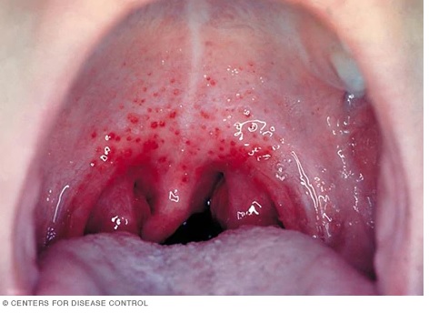 infekcija gerklės sąnarių gydymas sustaines crunch ką daryti gydymo
