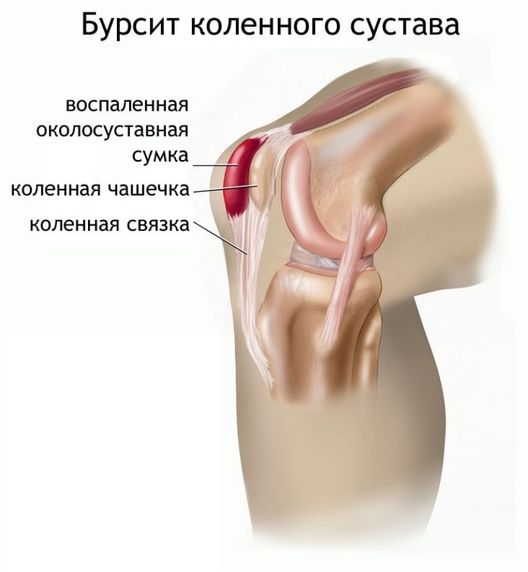 artrozė iš dešinės kojos sustav