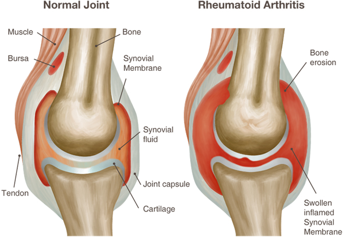 reumatoidinis artritas bursit iš alkūnės sąnario