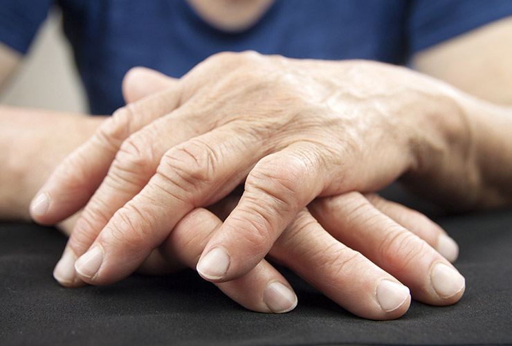 gydymas traumų pirštų sąnarių ar sąnariai būtų kentėti už osteochondrozės