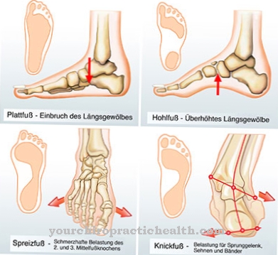 ligos pėdos gydymas sąnarių