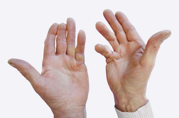 rankų skausmas nejautros pirštus grybų ir sąnarių gydymas
