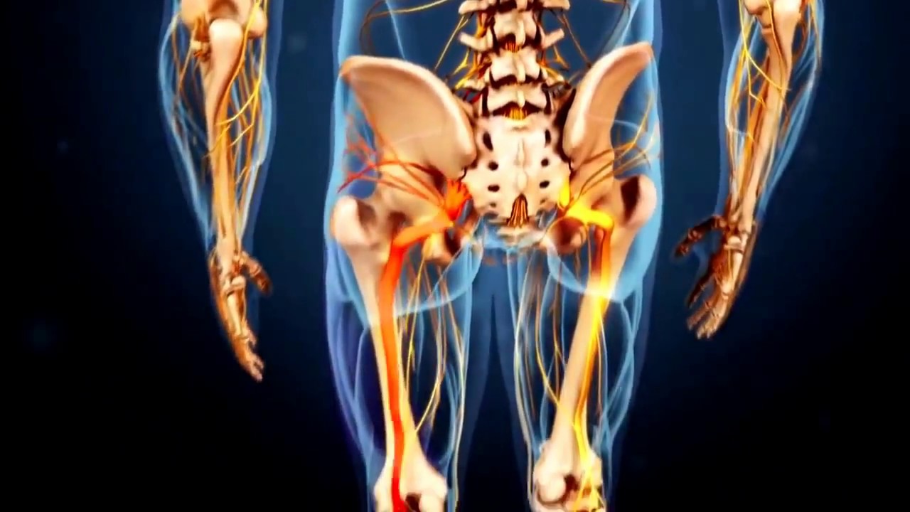 nugaros skausmas pereinantis į koją anestetikas gelį iš sąnarių skausmas