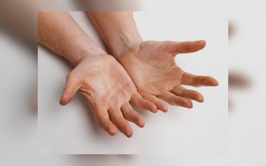 reumatoidinis artritas yra bendra