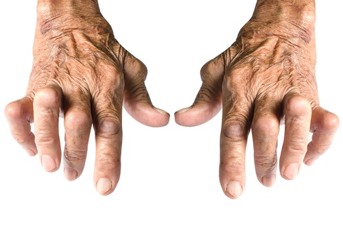artritas rankų valymo