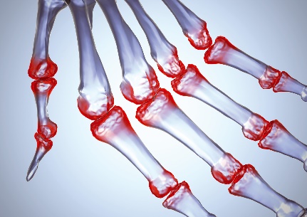 rankų artritas gydymas ėjimo skausmą sąnariuose bei raumenyse