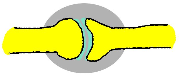 osteochondrozė kaklo kremai tepalai osteochondrozės