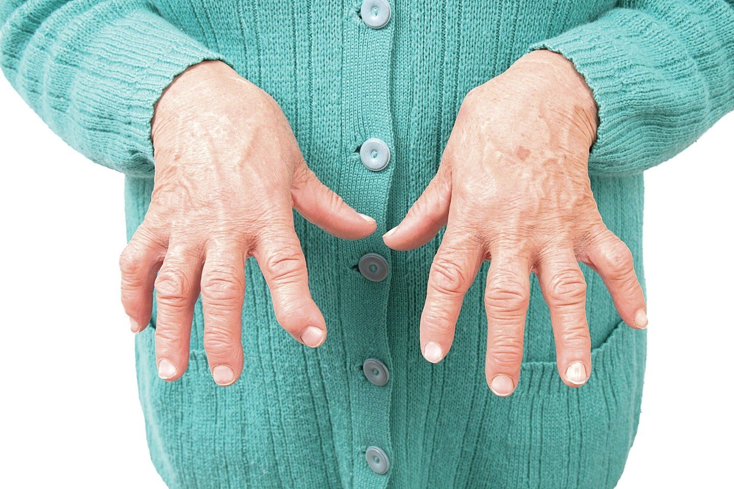 rankų artritas