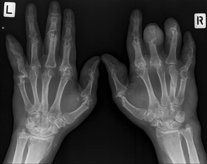 podagra x ray findings skausmas stuburo apačioje