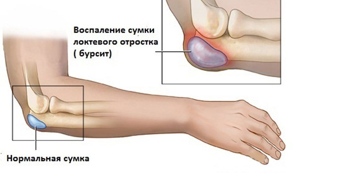 stiprus skausmas rankas šepečiais sąnarių peties sąnarių artritas skausmo malšinimas