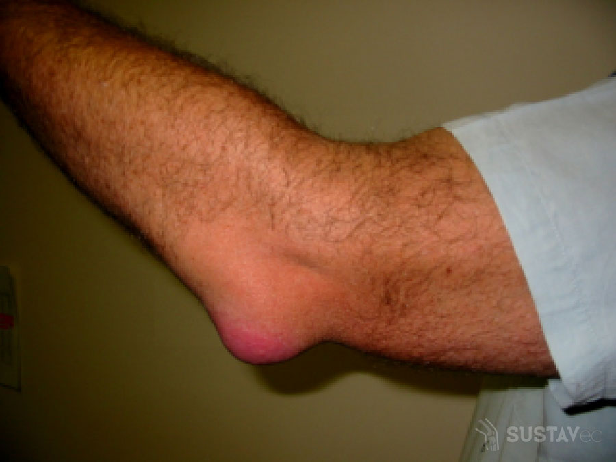 bursith iš alkūnės sąnario gydymas tepalai ir geliai skausmas dubens srityje pereinantis i koja
