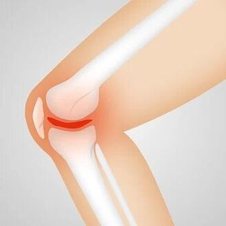 pašildyti tepalus į sąnarių artrozės ūminis artrozė kojų gydymas