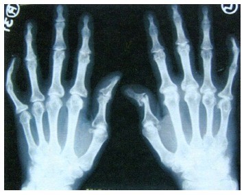 artritas ant dešinės rankos šepečiu į ką kreiptis dėl sąnarių skausmas