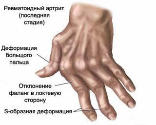 skauda piršto sąnarys ant rankos gydymas artritas 1 pėdų nutraukti gydymą