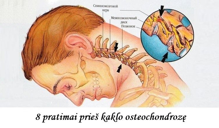 osteochondrozė kaklo
