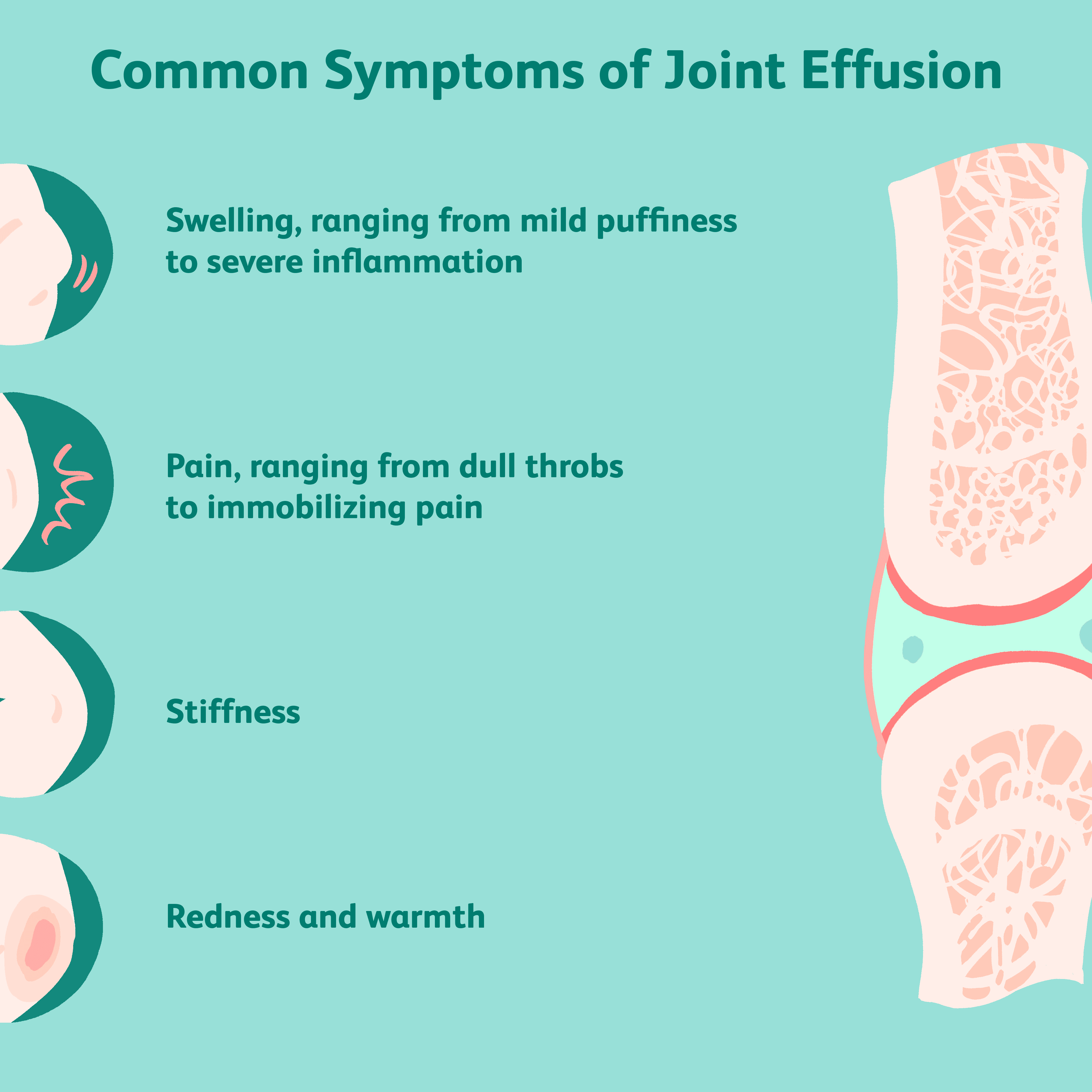 edema with joint effusion uždegimas pėdos gydymo liaudies gynimo sąnarių