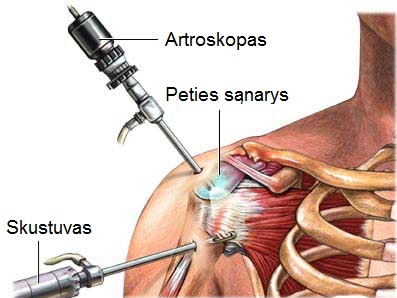 procedūros artrozė peties palaikimo