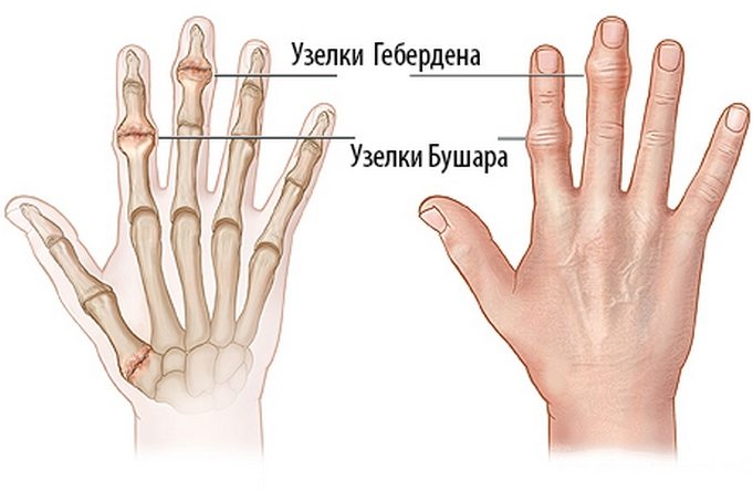 skystis pirštų sužalojimo sąnarių rheumatoid arthritis symptoms