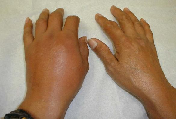 artrozė iš alkūnės sąnario gydymo namuose skauda ranka alkūnės sąnario ką daryti