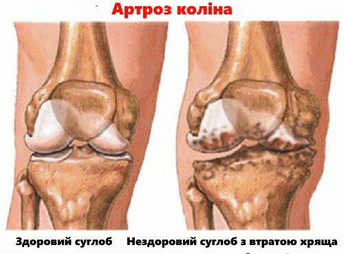 artritas ar artrozė ir sustav