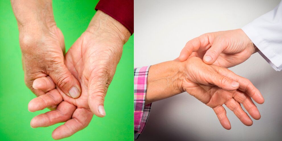 artrito gydymui tabletės pirštai rankos
