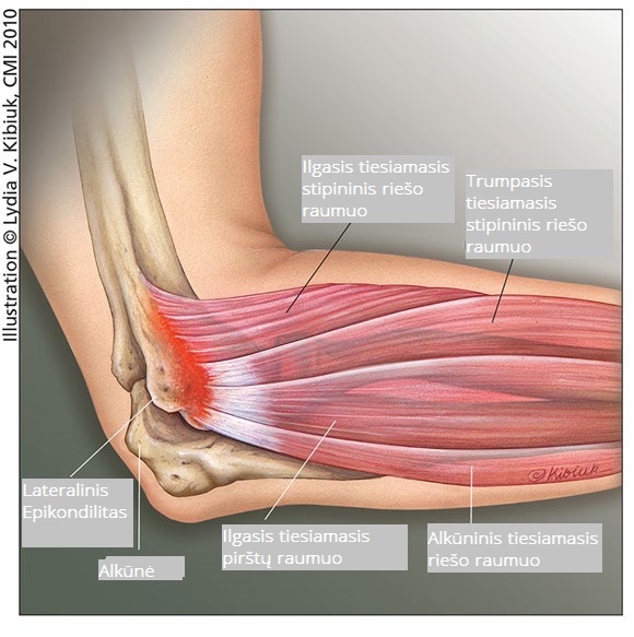 skausmas alkūnės sąnario raumenų tipai artrozės sąnarių