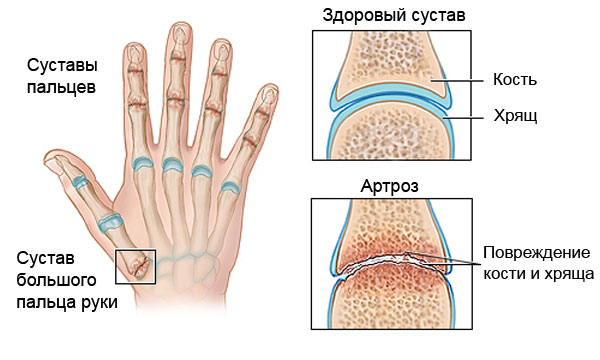 prevencija gydymas arthrisa