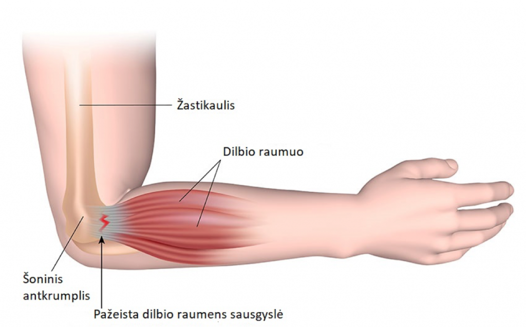 artrito sustava skauda peties sąnario po sužeidimo