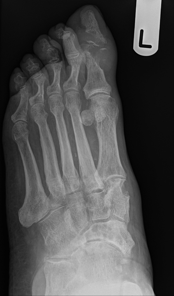 podagra x ray findings atsiliepimai apie artrozės peties sąnario gydymo