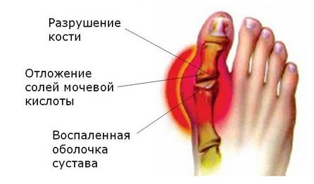 artrozė apdorojimo sistema priežastys osteochondrozės sąnarių