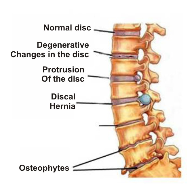 peržiūros nuo nemigos osteochondrozės metu naktinis nugaros skausmas